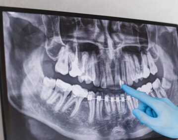 Doctor points to cured filled tooth in dental x-ray